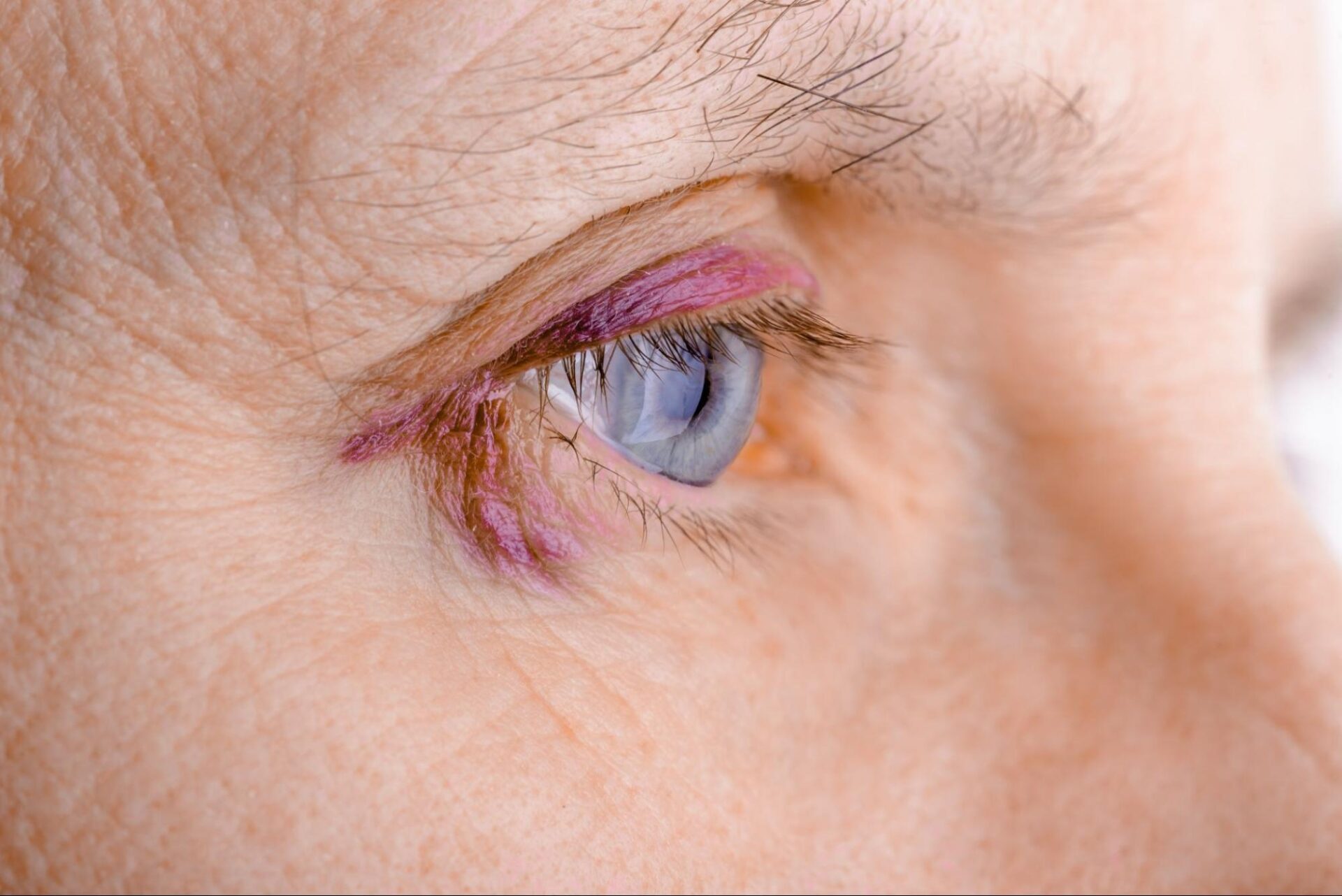 Eye injury types