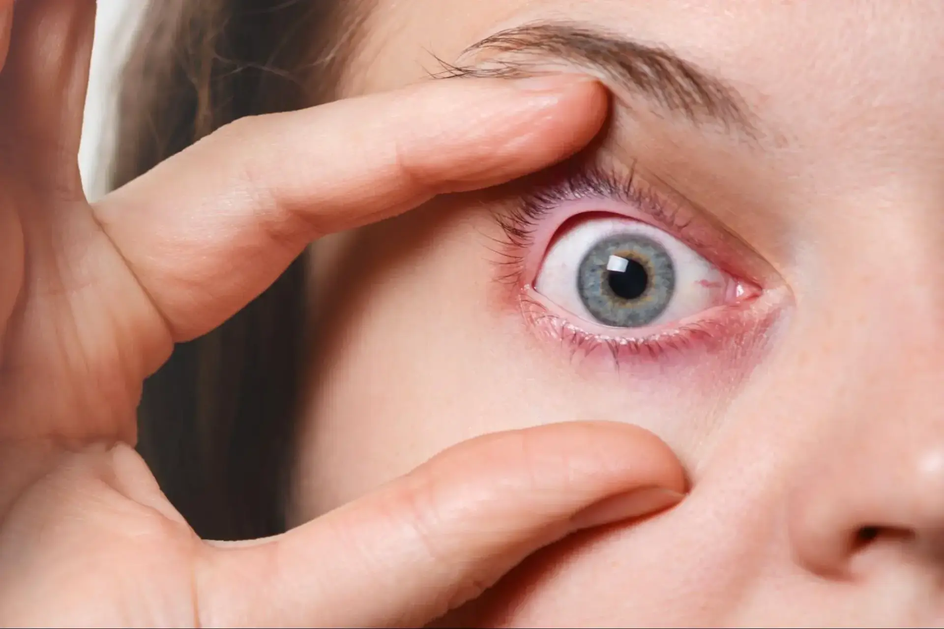 Woman showing stress rings in eyes